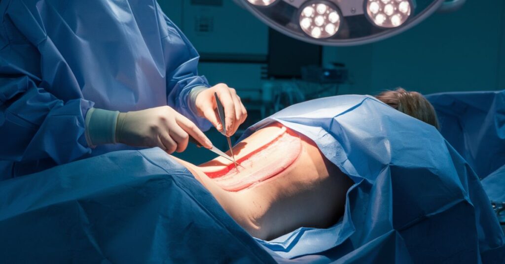 PSIF Surgery
